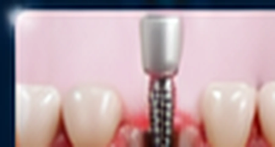 Abutment yerleştirme